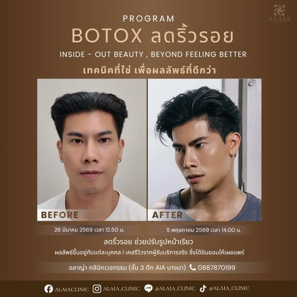 Program Botox ลดริ้วรอย Review Male 2